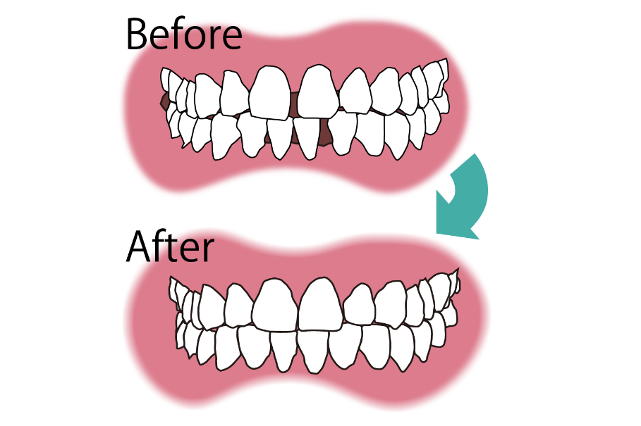 ダイレクトボンディングbefore&after