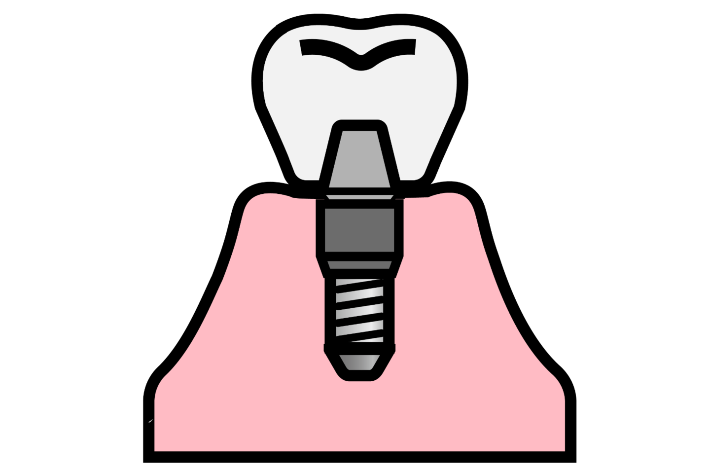 インプラントイラスト